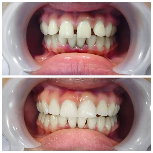 Full Mouth Reconstruction in Concord, CA